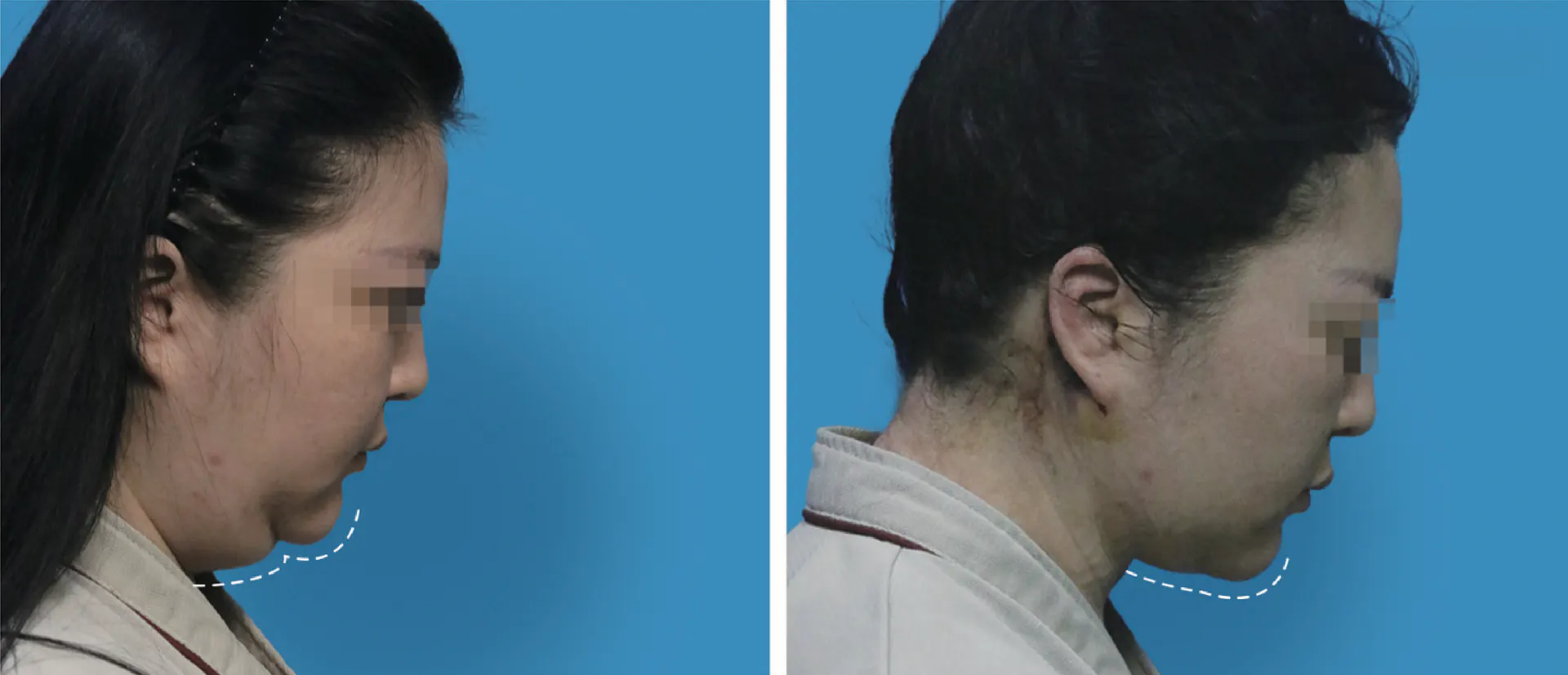 Facial liposuction 10