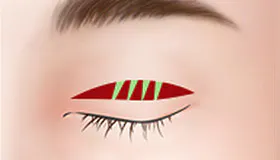 眼形矫正 4