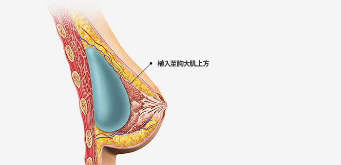 不同假体位置的手术方法 3