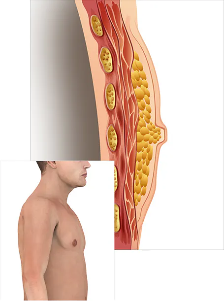 什么是男性乳房发育？ 1