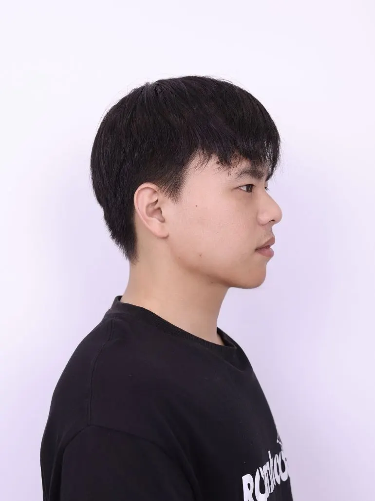下颌尖整形