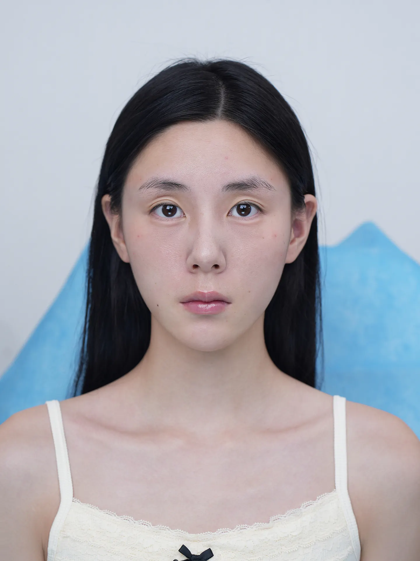 眼部整形前后照片 2