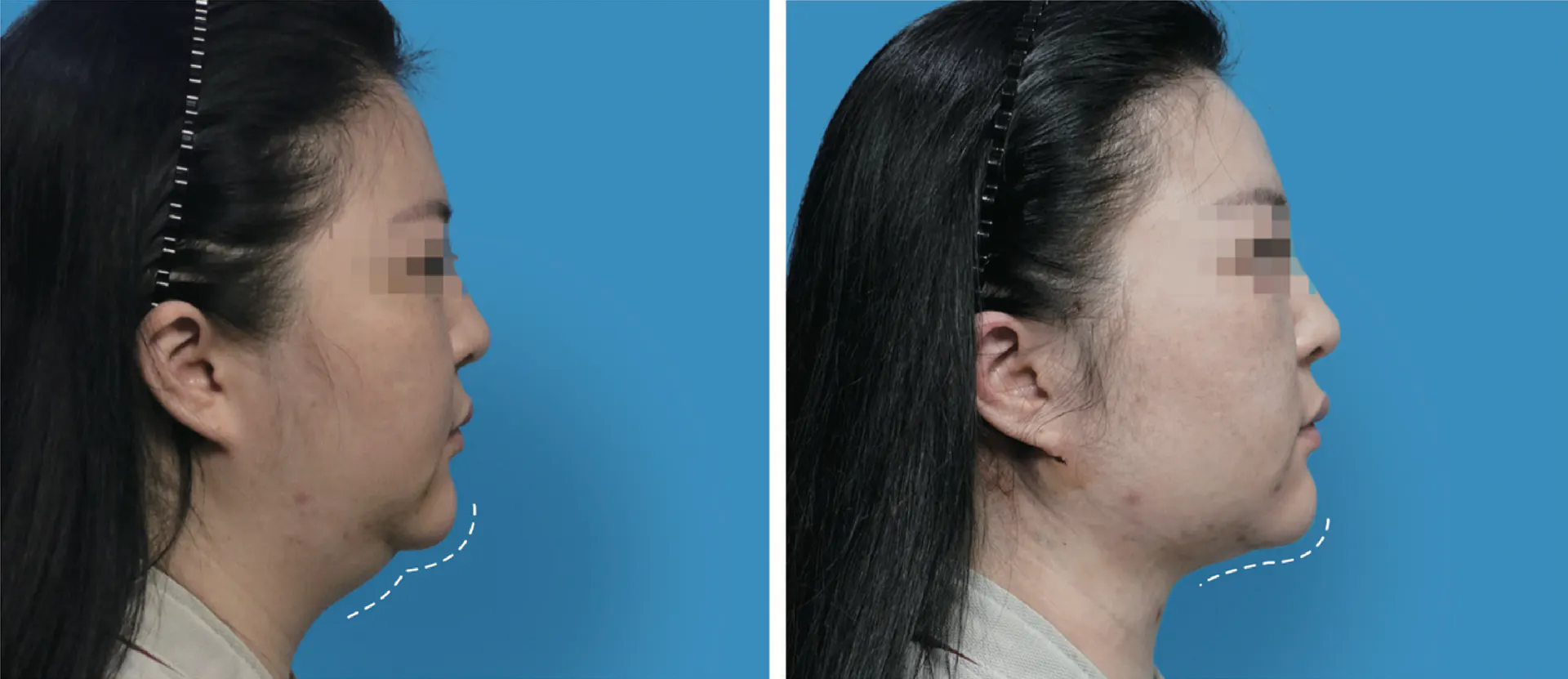 Facial liposuction 11