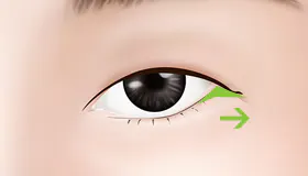 手术方法 2