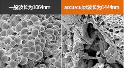 什么是AccuSculpt激光溶脂术？ 1