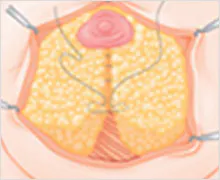 为了更加令人满意的手术结果 2