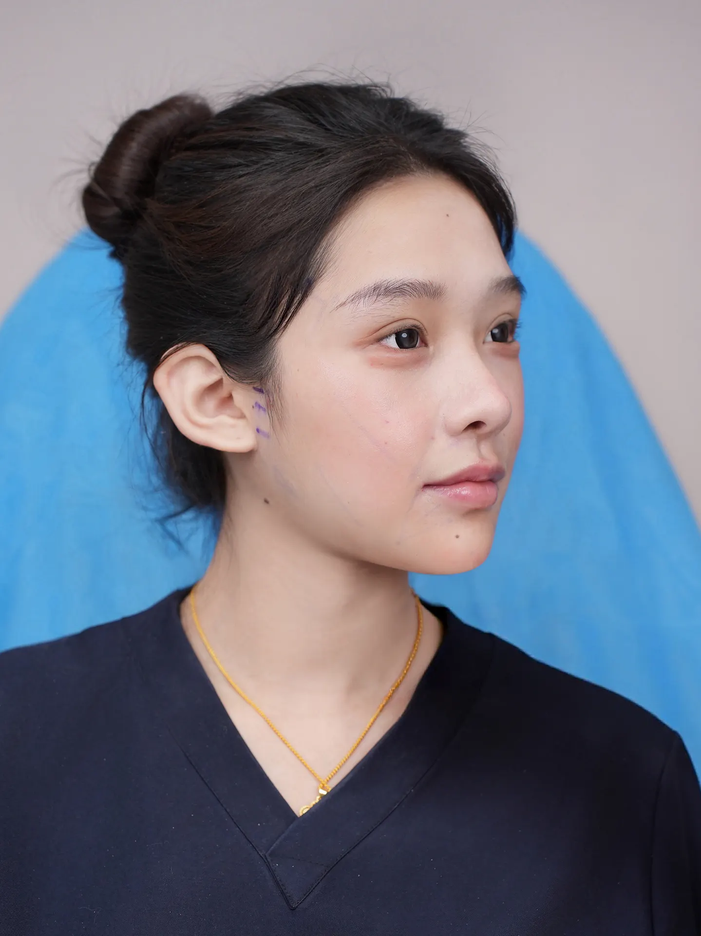 鼻部修复手术后记 1