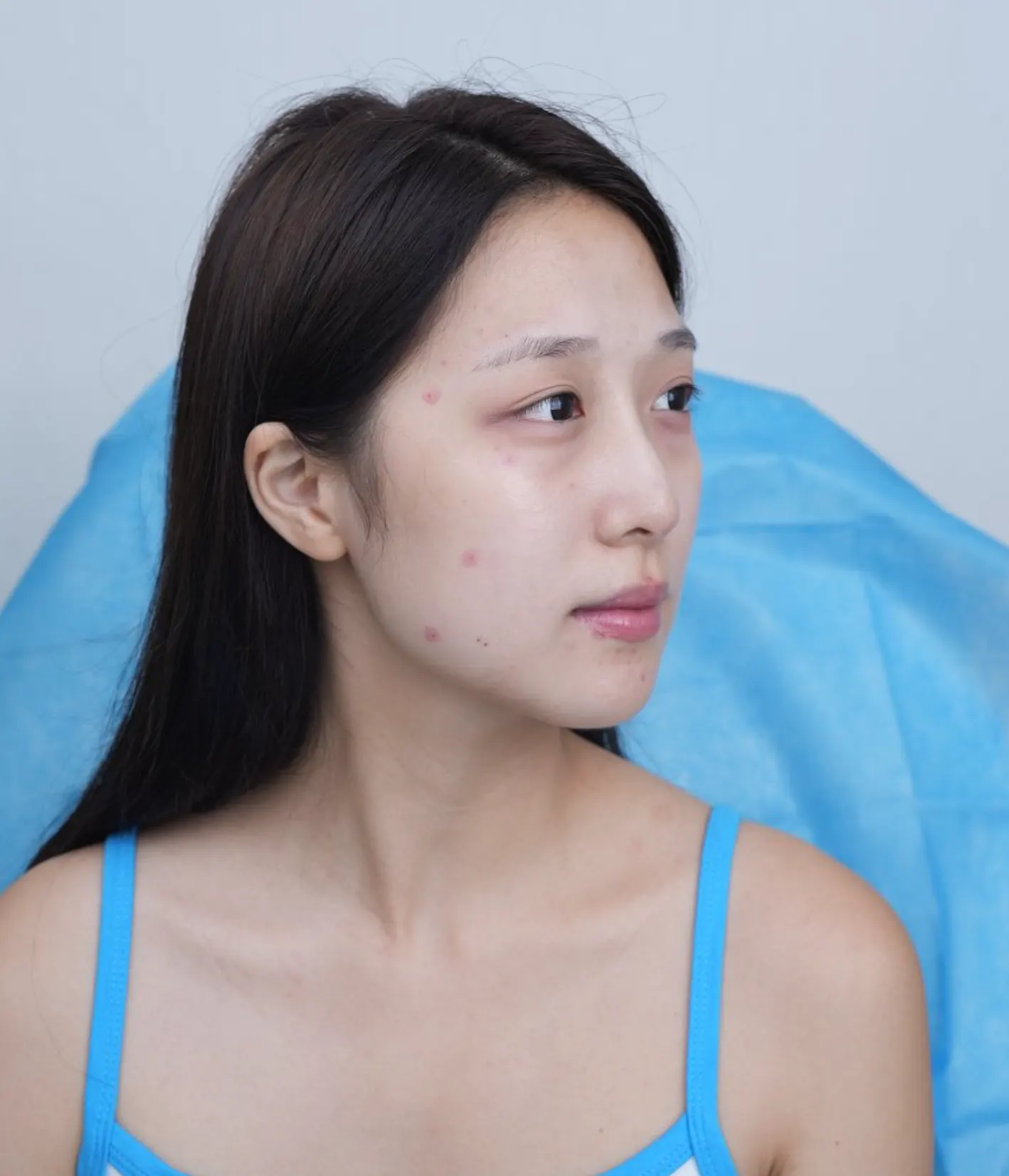 REAL双眼皮手术方法 3
