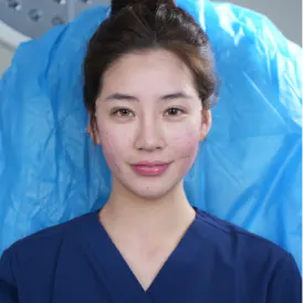 开眼角手术后记 2