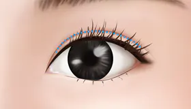 手术方法 5