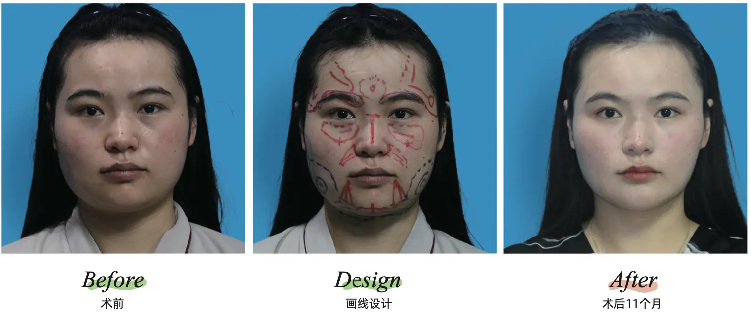 Facial liposuction 7