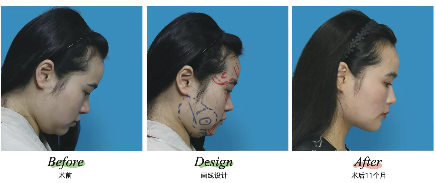 Facial liposuction 8