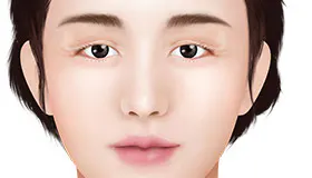 眼形矫正 2