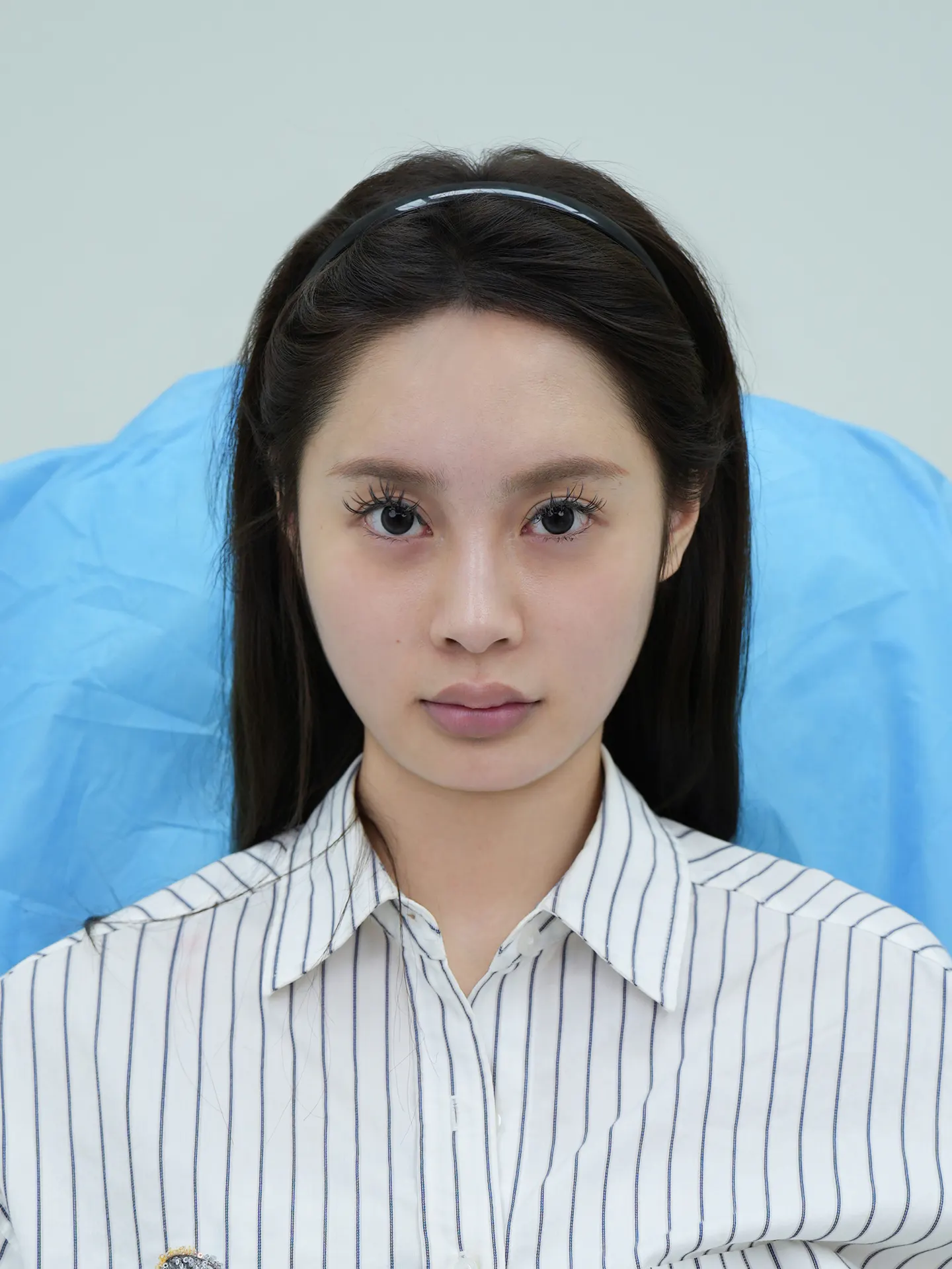 长颌矫正 3