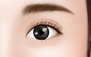 双眼皮手术方法 3