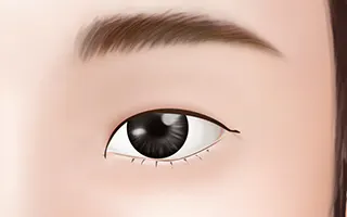 双眼皮手术方法 2