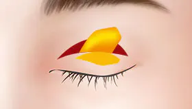 手术方法 2