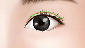 手术方法 4