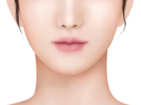 微笑提拉手术方法 3