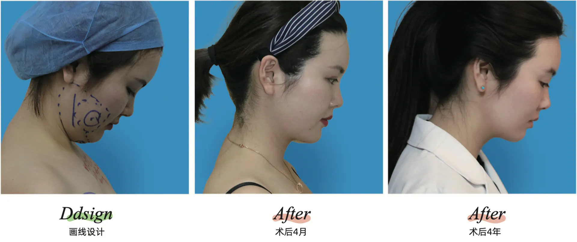 Facial liposuction 3