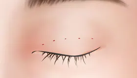 手术方法 2
