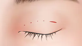 手术方法 1