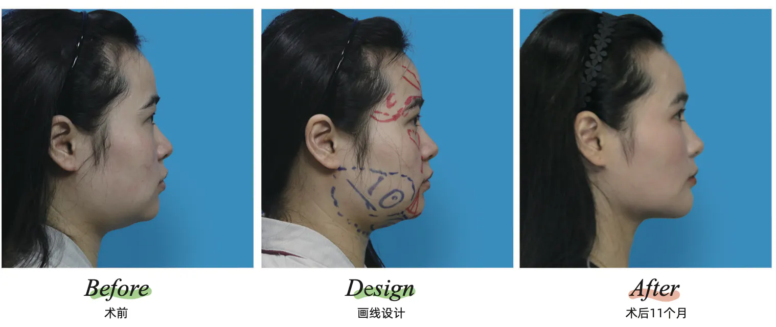 Facial liposuction 6