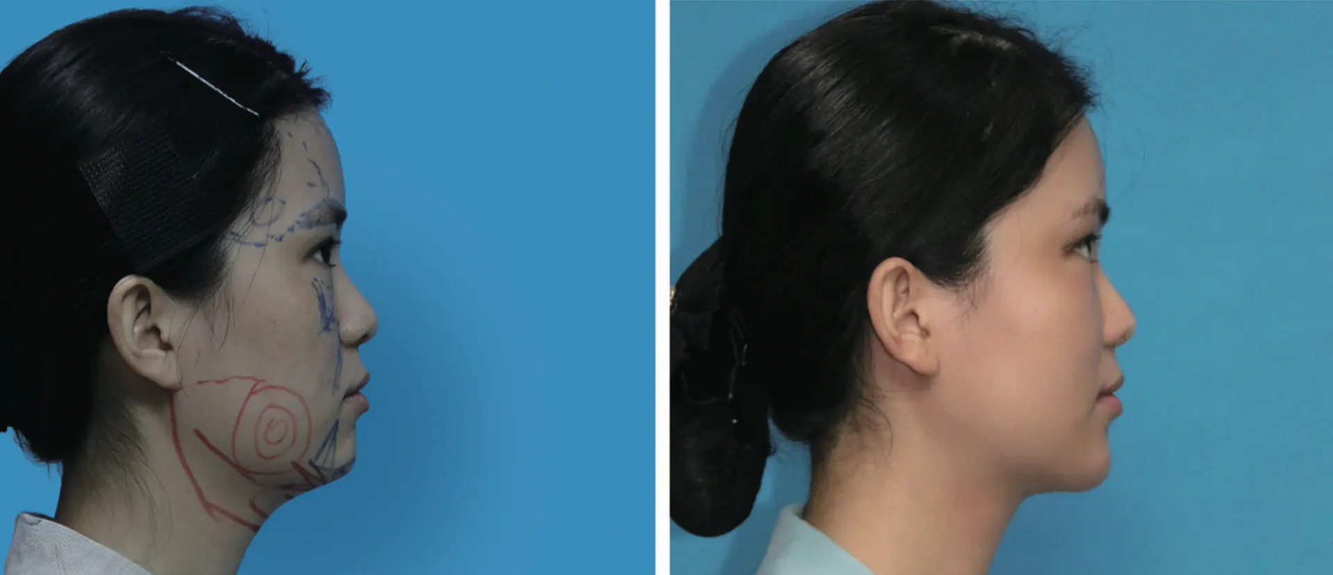 Facial liposuction 16