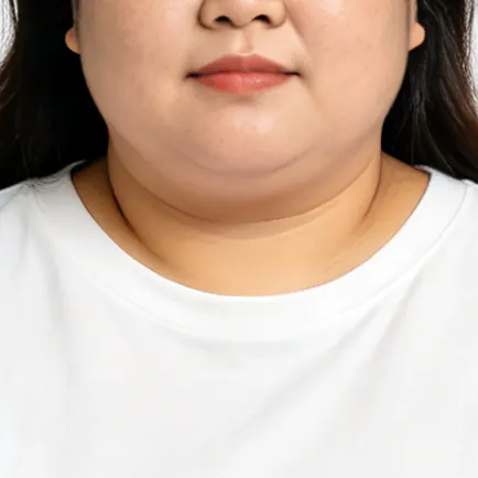 REAL综合吸脂术 4