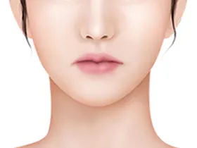 微笑提拉手术方法 1