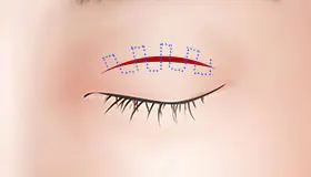 手术方法 3