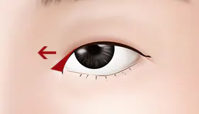 手术方法 2