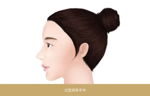 过度颌骨手术