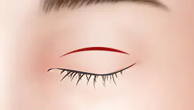 手术方法 1
