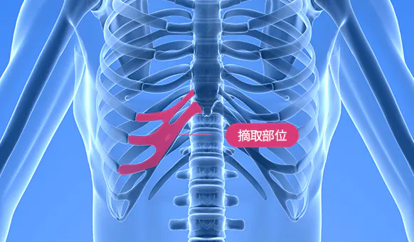 自体软骨 3