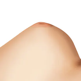 改善乳头重度内陷的手术方法 1