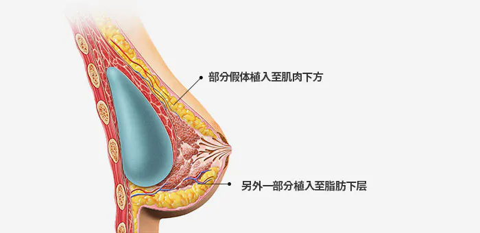 不同假体位置的手术方法 1