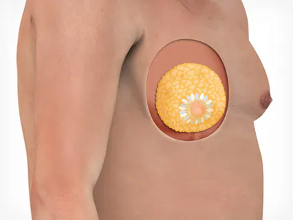 男性乳房发育的种类 2