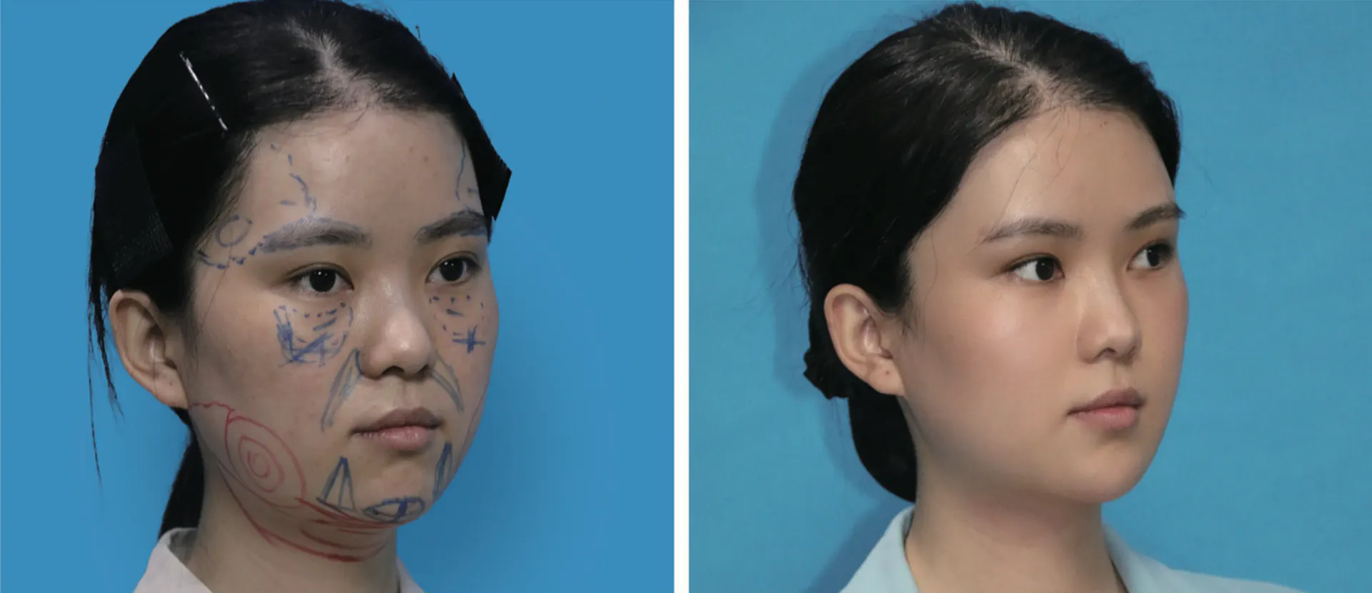 Facial liposuction 15