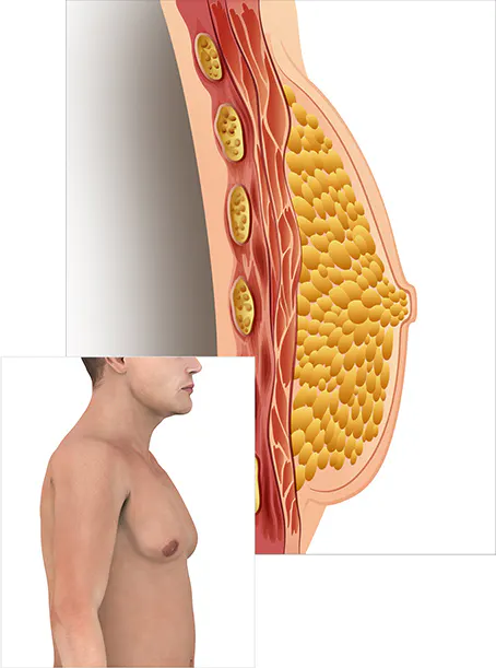 什么是男性乳房发育？ 3