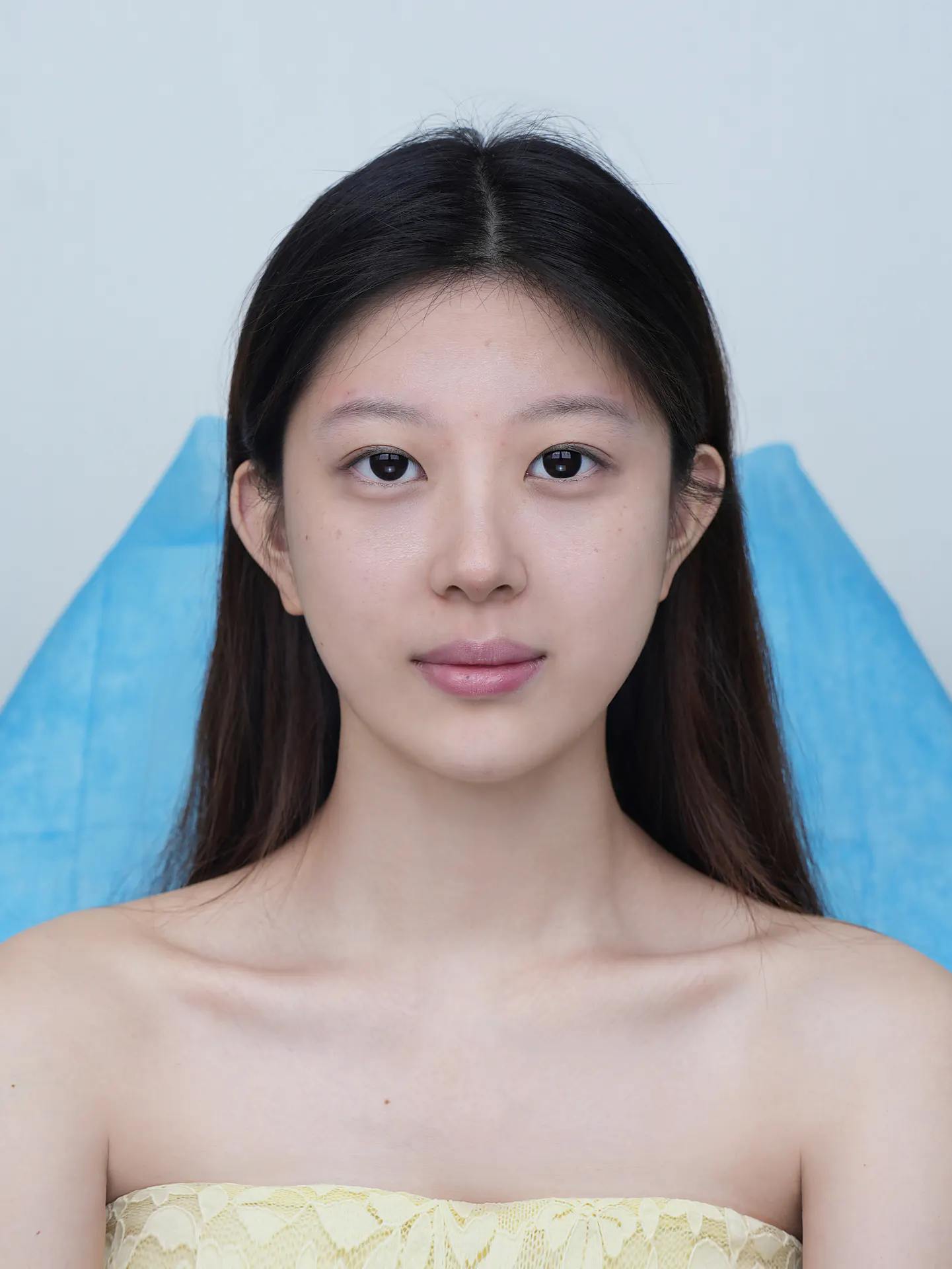 眼部整形前后照片 1