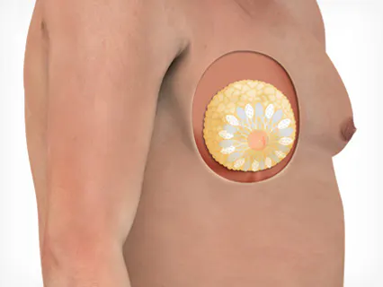 男性乳房发育的种类 1