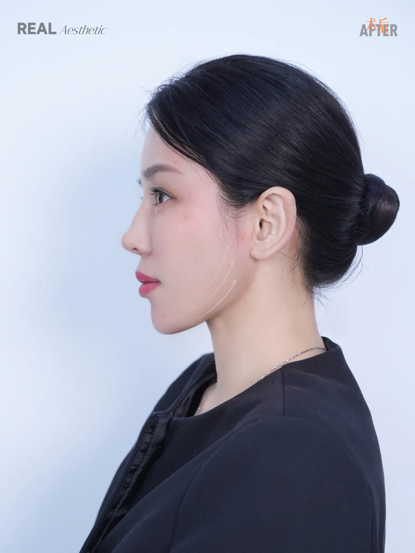 REAL 三重面部吸脂术 2