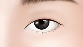 手术方法 1
