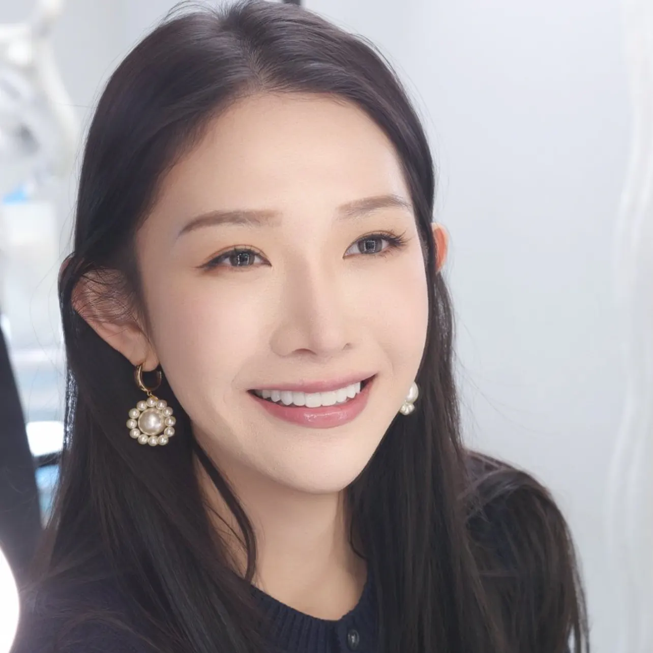 数字化微创瓷贴面术后记 1