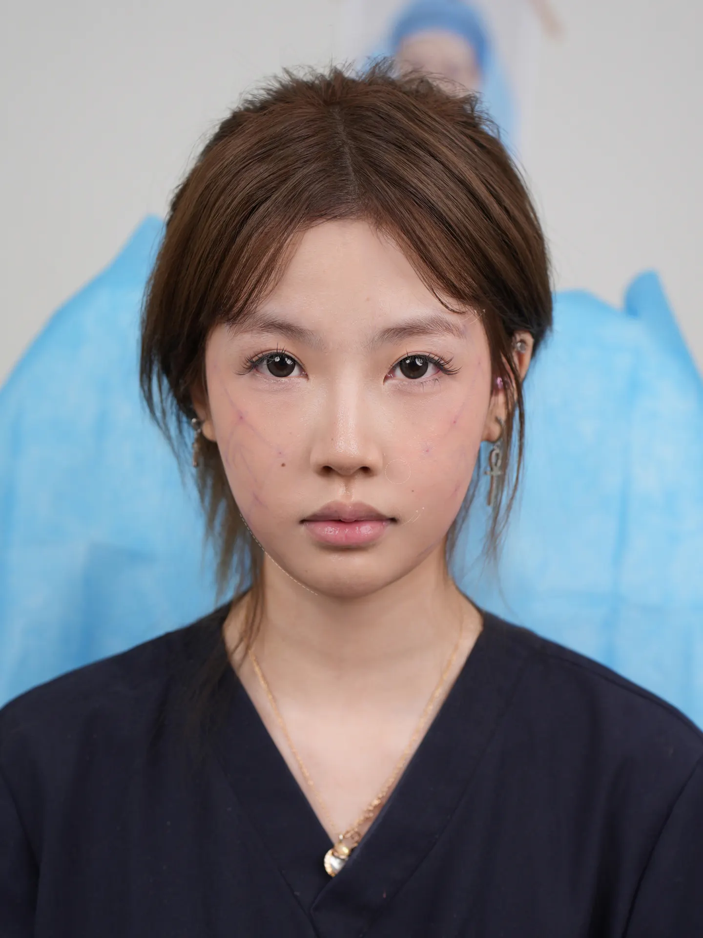 内窥镜额部除皱术_内窥镜 2