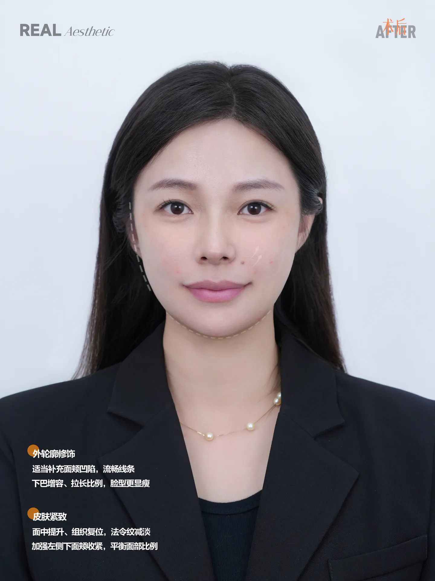下巴不对称 1