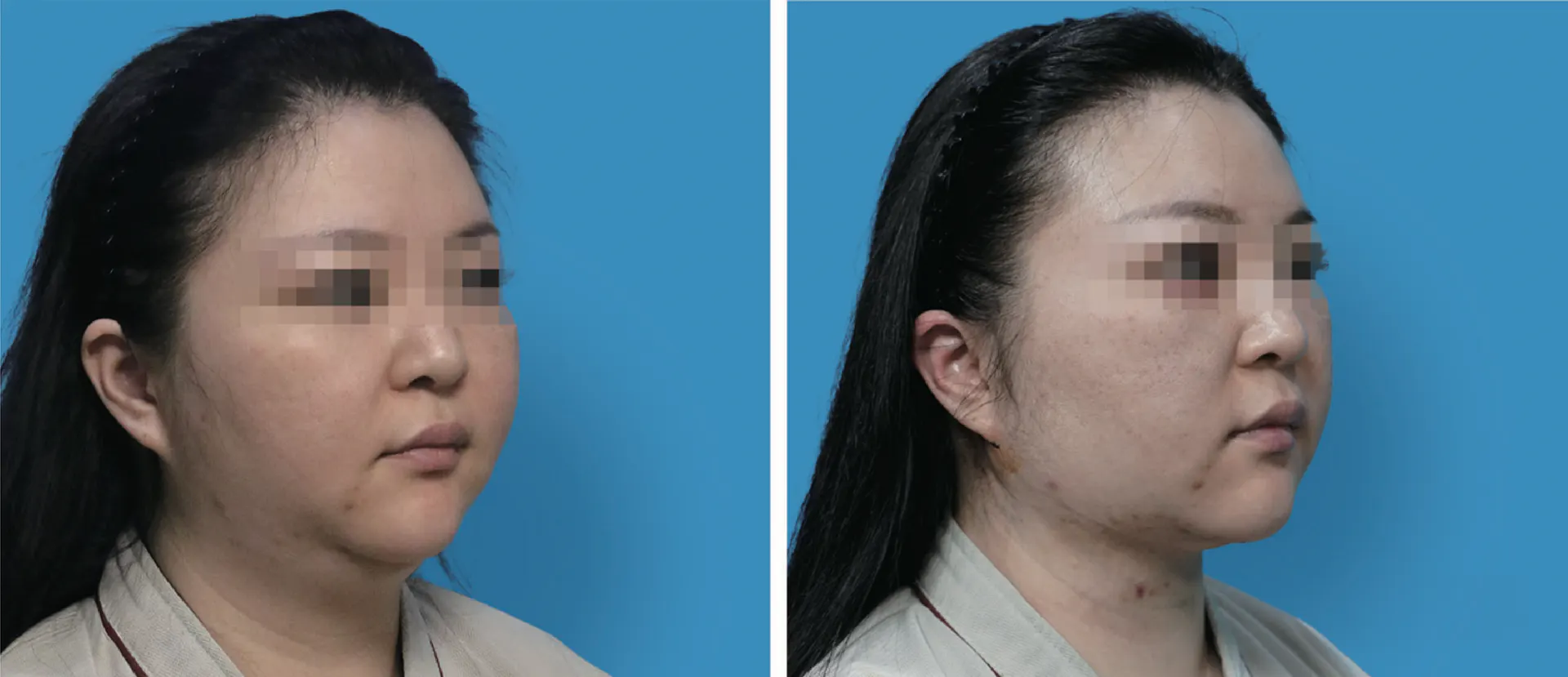Facial liposuction 12
