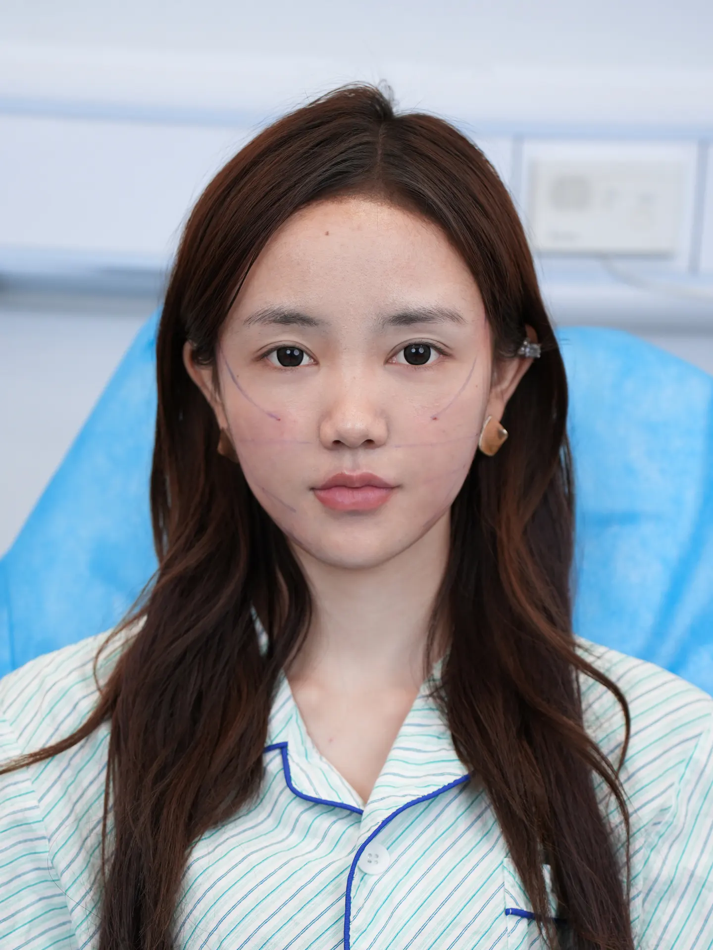 上眼睑手术 1