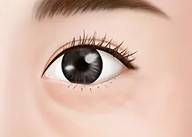 如果你有严重的黑眼圈 1